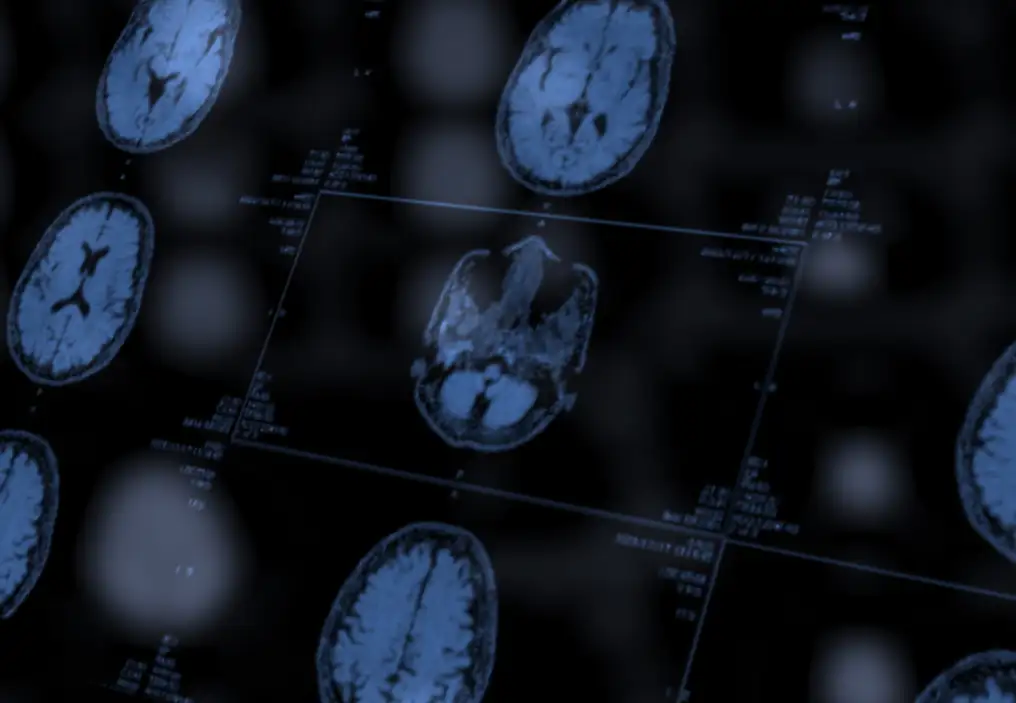 A view of MRI films showing cross sections of a brain. There are blurry reflections of the brain pictures in the foreground, giving the image an abstract air.